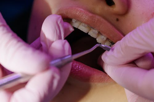 口腔溃疡发病后需要药物治疗吗？严重得治疗