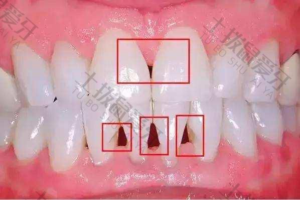 牙齿矫正出现黑三角