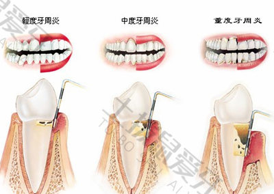 牙周炎牙齿松动可以正畸嘛