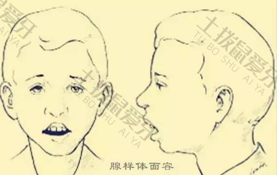 腺样体面容