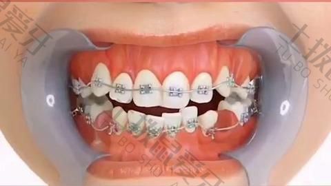 牙齿矫正哪种比较好?