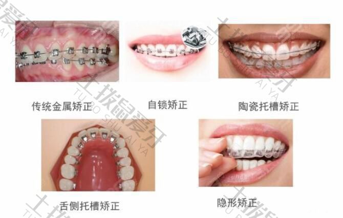 矫正牙齿一般要花多少钱