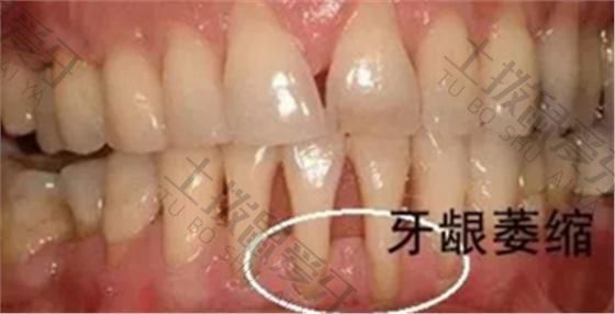 牙齿矫正后遗症