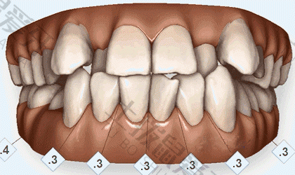 牙齿排列不齐怎么矫正