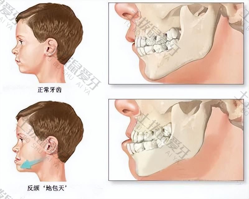 地包天牙齿矫正
