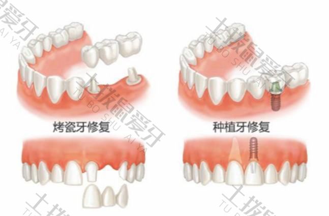 镶牙和种植牙