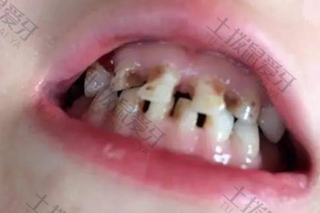 洗牙会损害牙釉质吗