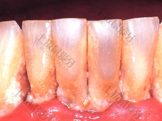 牙髓炎治疗周期