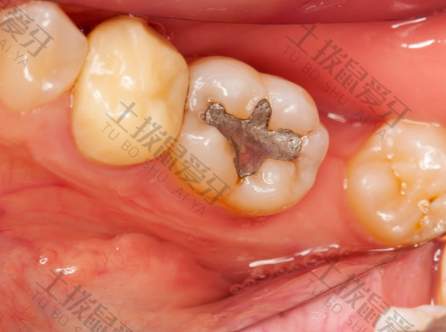 牙髓炎治疗周期