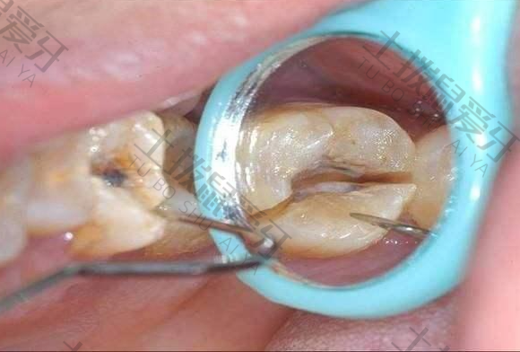 牙髓炎治疗费用大概多少钱