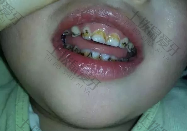 牙髓炎治疗费用大概多少钱