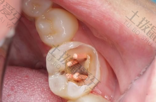 牙髓炎治疗全过程