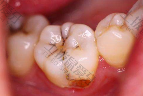 牙髓炎会自愈吗
