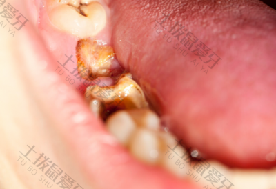 牙髓炎治疗要多久 牙髓炎治疗后为什么还痛