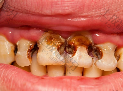 牙髓炎是怎么引起的