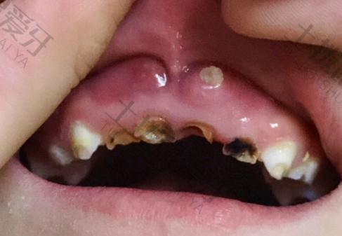 牙髓炎治疗后为什么还痛