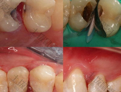 牙髓炎治疗方法 牙髓炎治疗步骤
