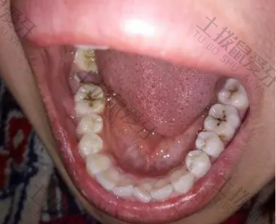 龋齿控制措施 龋齿的药物治疗
