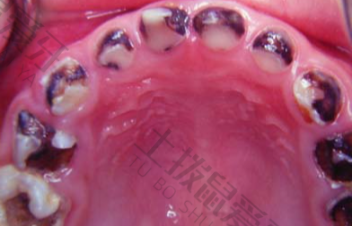 龋齿的症状 龋齿需要怎么治疗