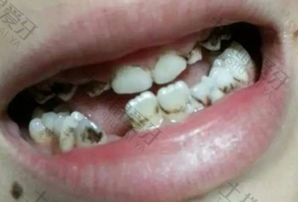 牙周炎是怎么引起的