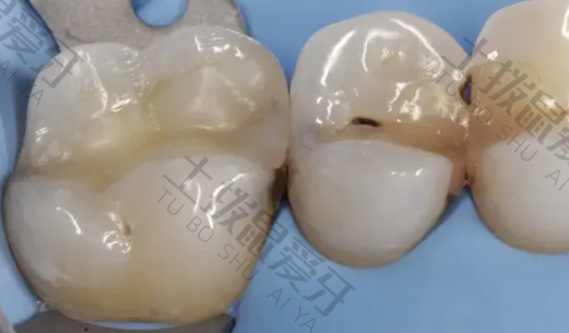 牙齿矫正价格多少钱