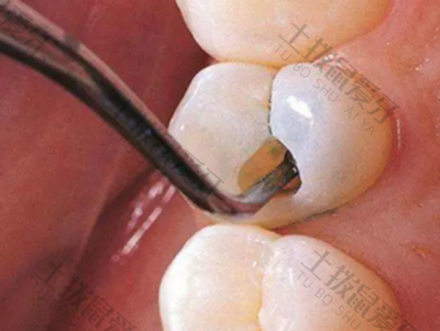 牙周炎治疗周期多久 牙周炎怎么治疗最有效