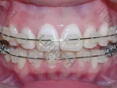 牙齿矫正成人价格 牙齿矫正器的种类及价格