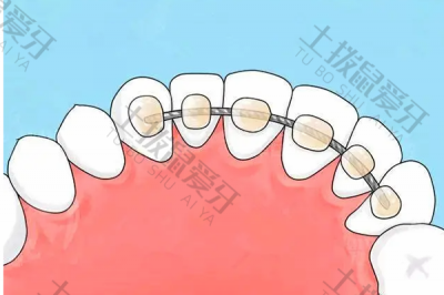 传统牙齿矫正的价格 牙齿矫正年龄