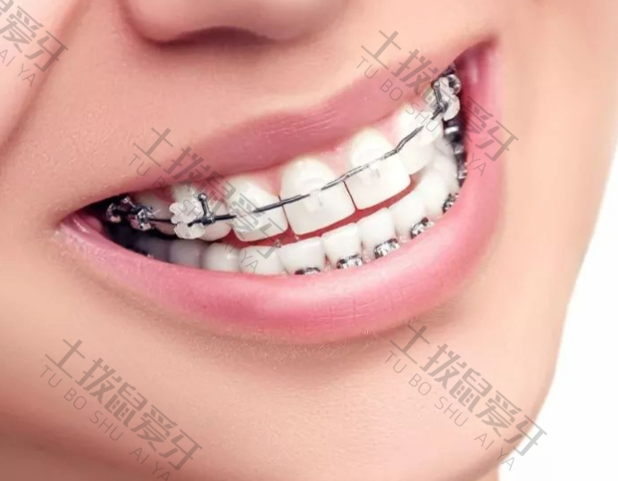 全隐形牙齿矫正价格