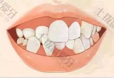 儿童口腔早期矫正牙齿价格 局部牙齿内凹矫正价格多少
