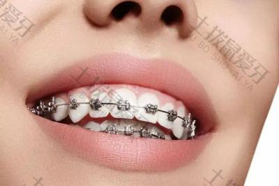 正畸牙齿矫正器价格是多少 二次陶瓷矫正牙齿价格