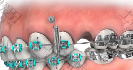 牙齿矫正金属矫正价格