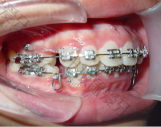 牙齿矫正稀疏价格 牙齿前期矫正价格