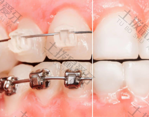 牙齿矫正价格区别