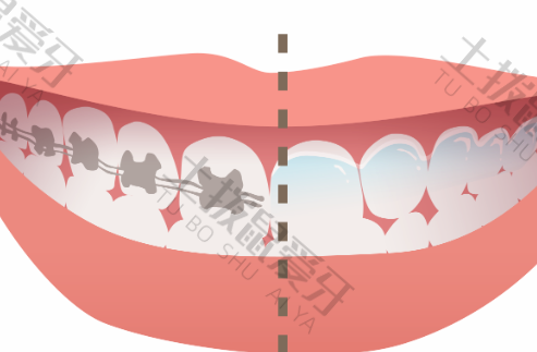 牙齿矫正价格区别