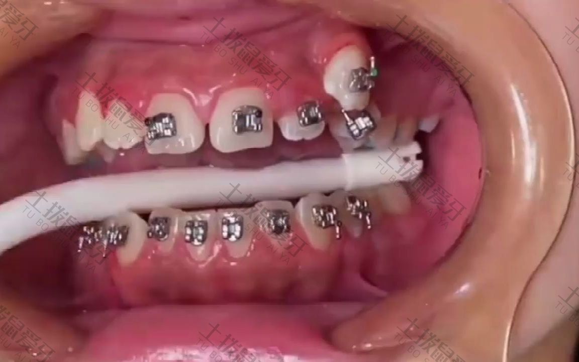 牙齿矫正金属价格
