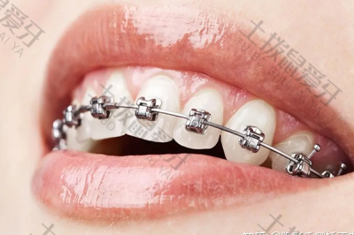 牙齿排列矫正价格　牙齿凹陷矫正价格