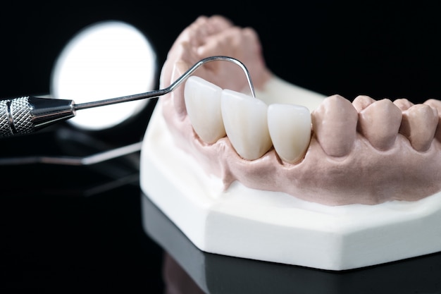 常见牙齿贴面材质及特点