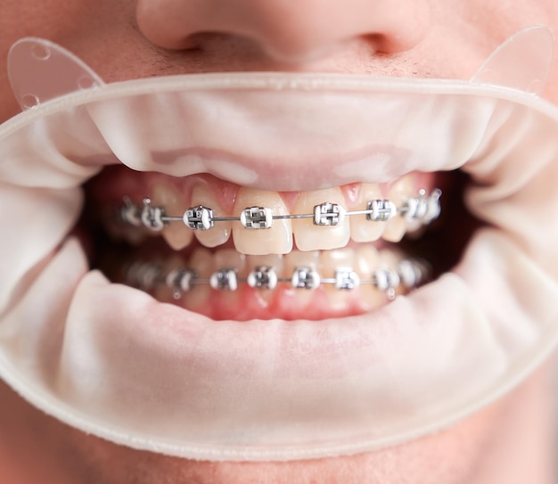牙齿矫正的重要性