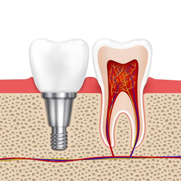 延期种植牙和即刻种植牙的区别