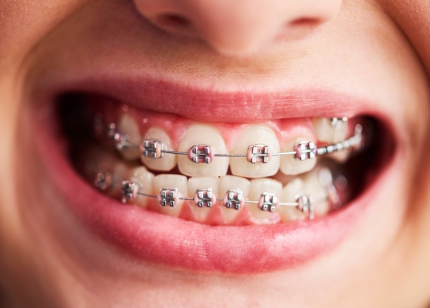 九岁孩子牙齿反颌矫正的重要性