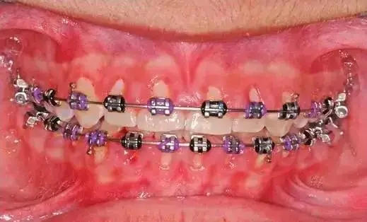 牙周病对正畸的影响