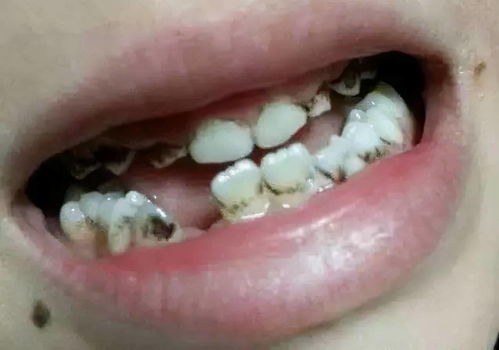 儿童龋齿的危害