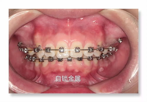 牙齿外凸的矫正方法