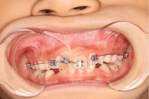牙齿少的矫正方法