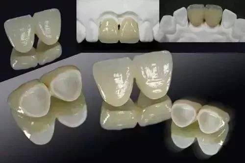 什么情况下适合做烤瓷牙