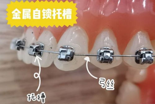 牙齿矫正的其他注意事项