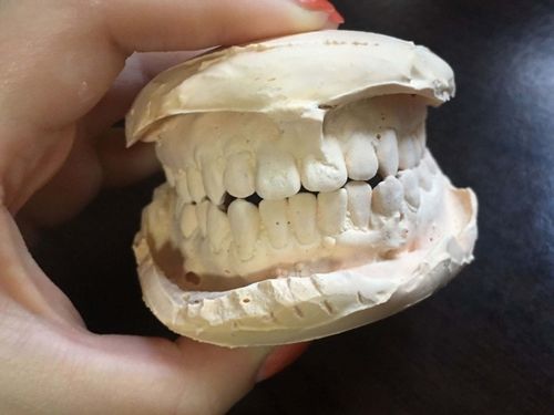 常见的取口腔模型材料