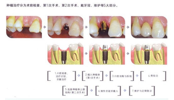 种植牙过程