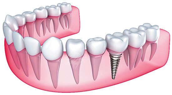 植牙贵和哪些因素有关